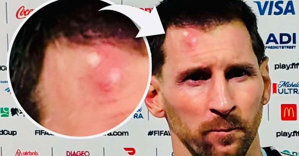 Messi sưng vêu trán sau trận thắng Cabo Verde: Vì sao nên nỗi? - hình ảnh - new88jl.com
